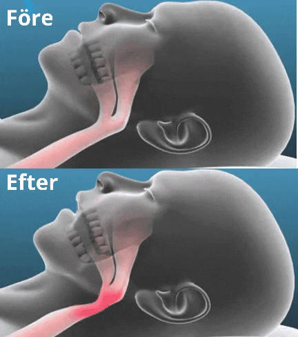 SnoreEase™ — Silence Snoring Instantly for Energized, Peaceful Mornings