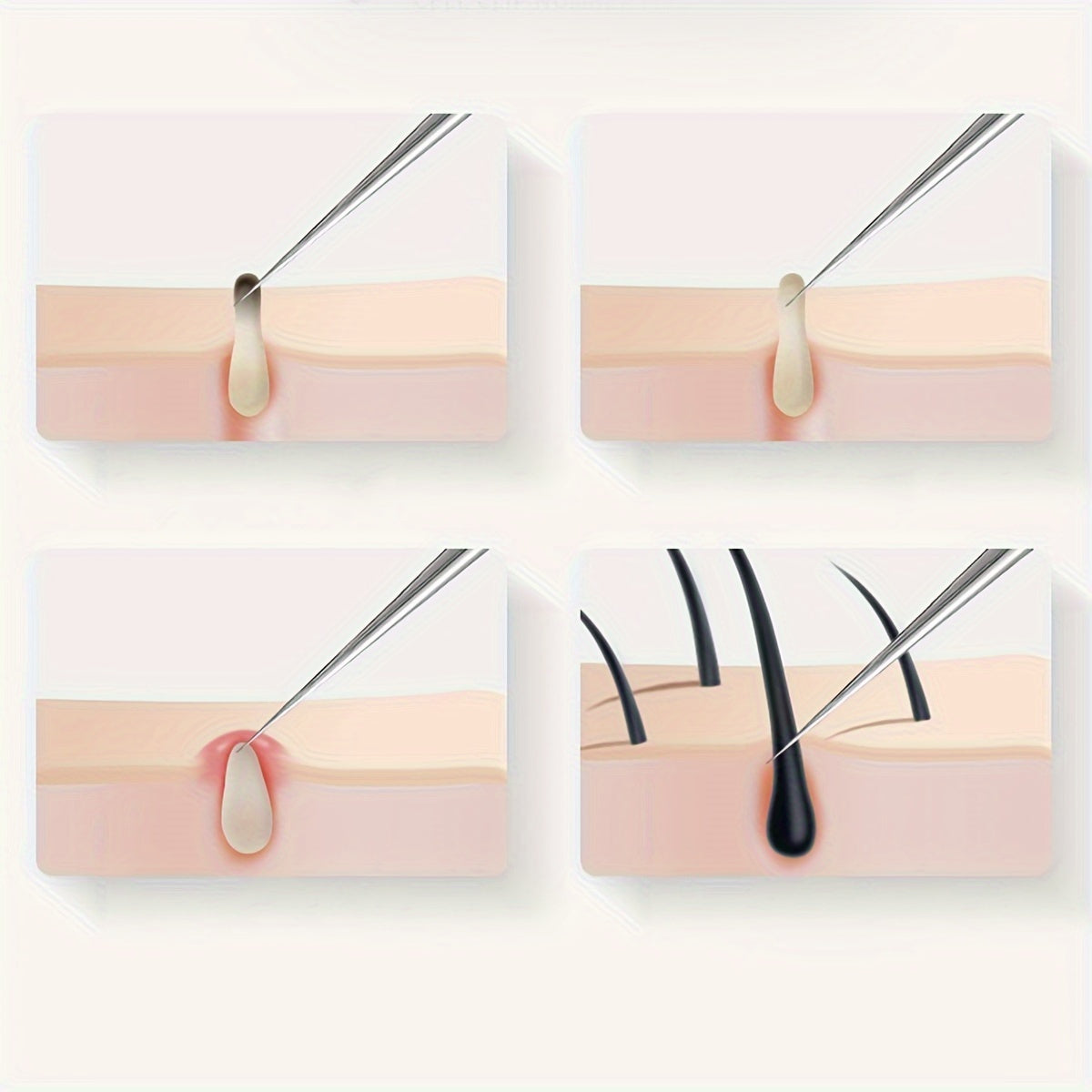 ClearSkin Pro - Stainless Steel Blackhead and Whitehead Remover