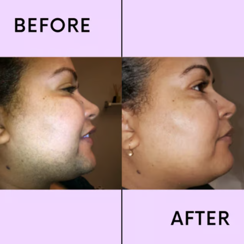 Radianta™ — Reveal Silky Smooth, Hair-Free Skin Without Any Pain or Irritation