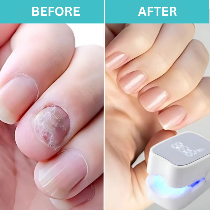 50% Discount Temporary | Fungi Eliminator