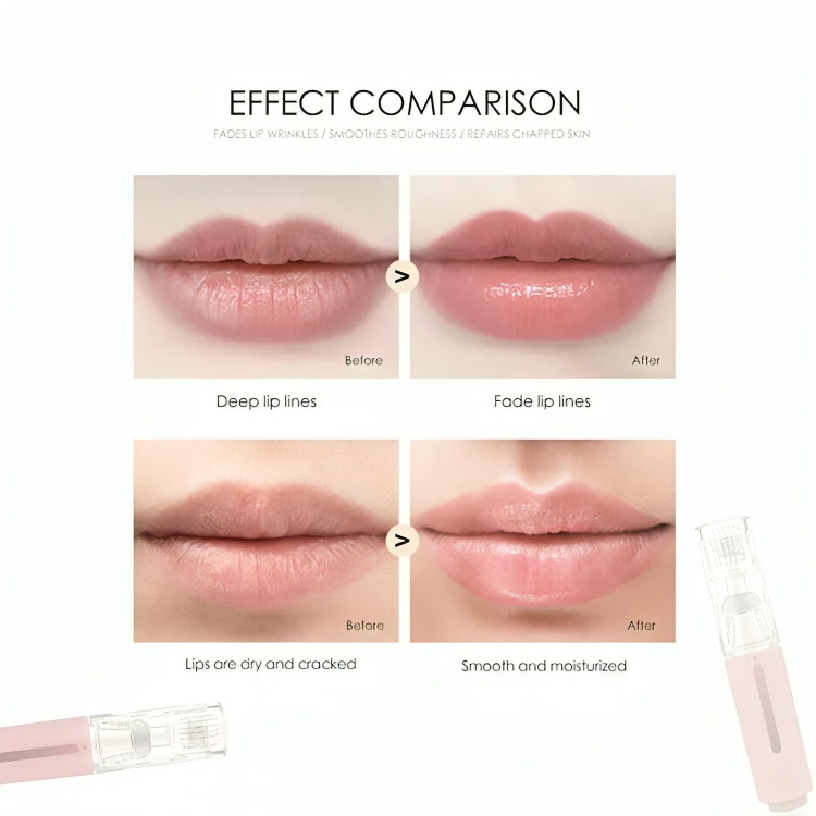 Temporary 50% Discount | Lip Enhancement | Achieve Full & Soft Lips!