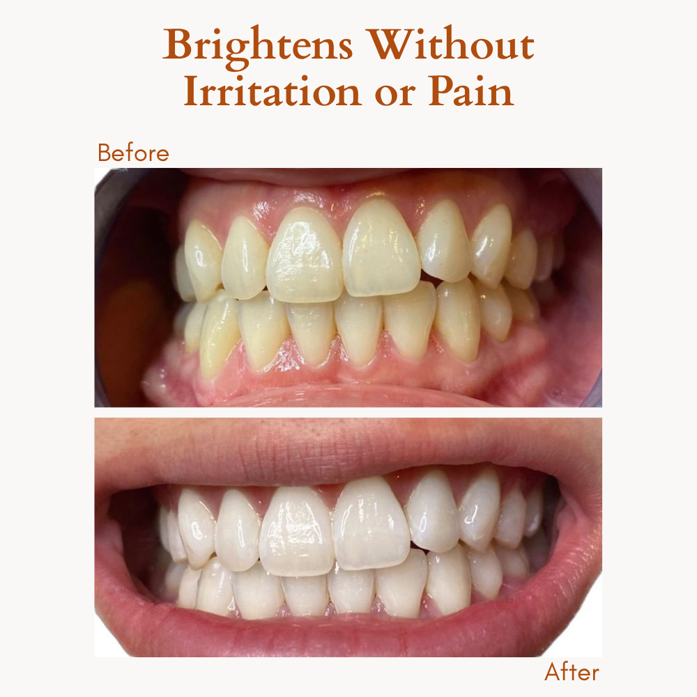 DiamondShine™ Whitening Pen — Unleash a Radiant Smile That Commands Attention Instantly