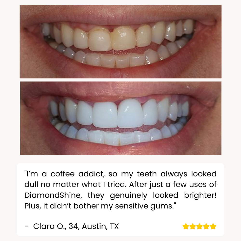 DiamondShine™ Whitening Pen — Unleash a Radiant Smile That Commands Attention Instantly