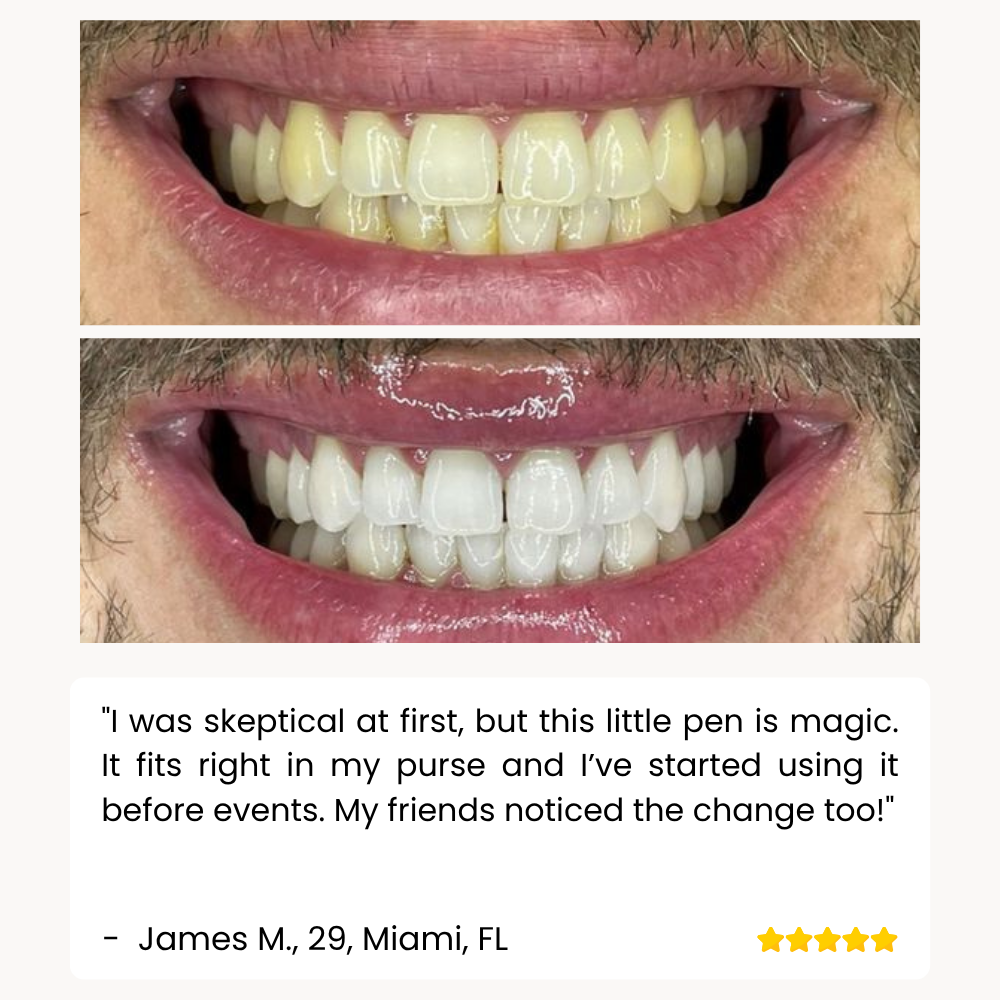 DiamondShine™ Whitening Pen — Unleash a Radiant Smile That Commands Attention Instantly