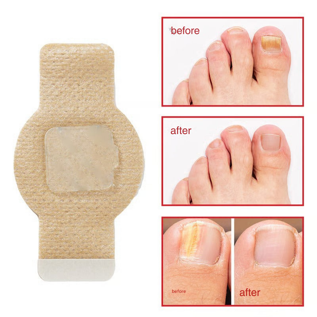 SilkDerm™ Nail Renewal Patches — Clear, Strong Nails That Make You Proud to Bare Your Feet
