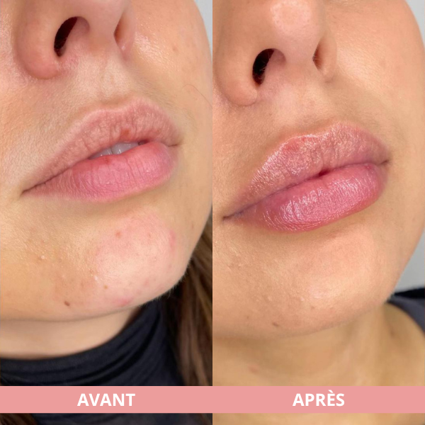 Arvilaro | Kit Ritual Lips - Thicker & Shiny lips in minutes