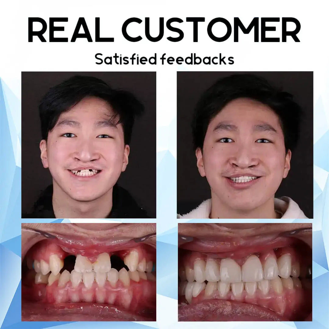 PureDenté™ — Unlock the Freedom to Smile Boldly with Unmatched Comfort and Confidence