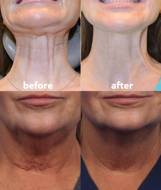 Wrinkle Reduction Pads