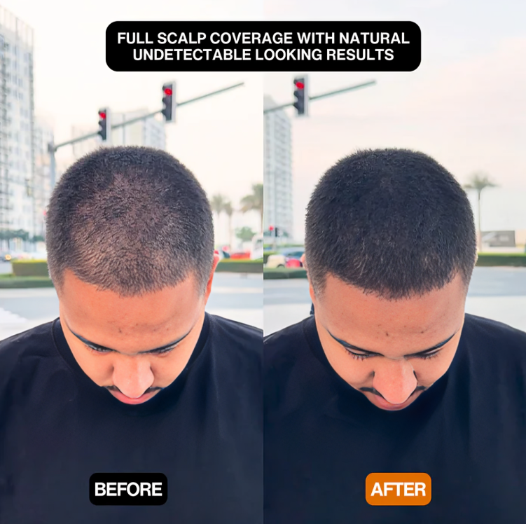 Quick Solution for a Natural, Voluminous Hairline