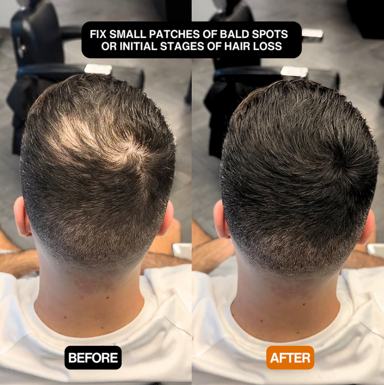 Quick Solution for a Natural, Voluminous Hairline