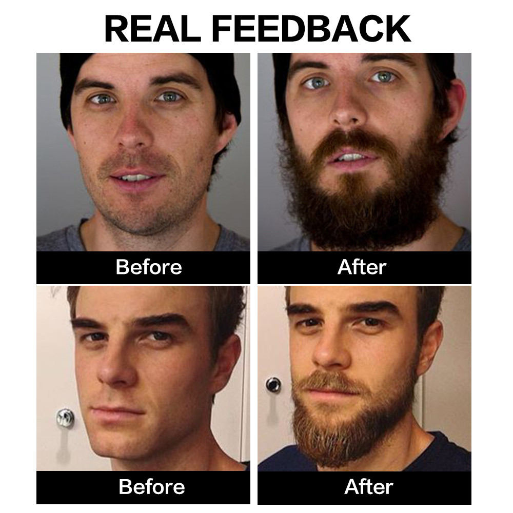 Complete Beard Restoration Solution - Foliage Repair