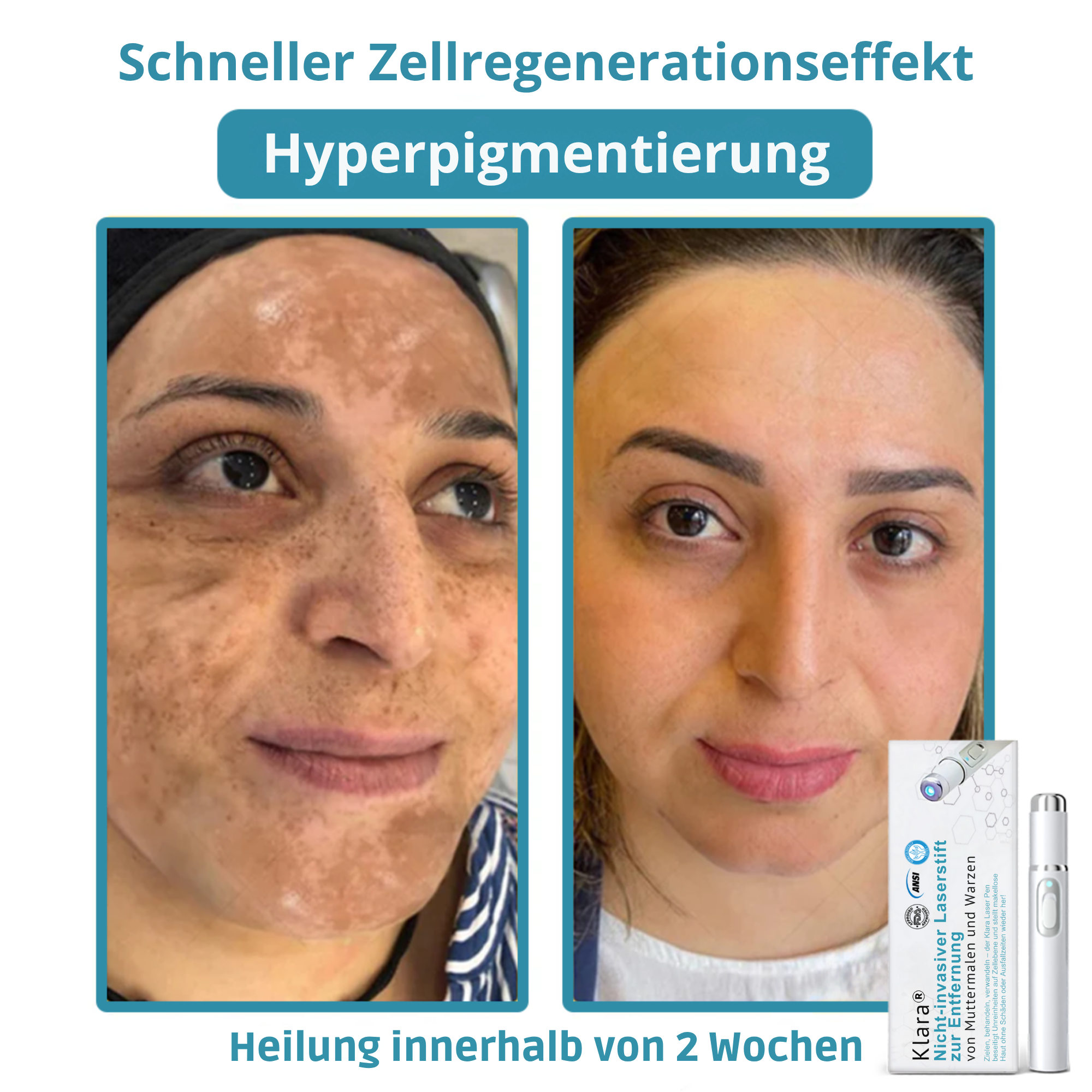 Painless Laser Pen for Flawless Skin and Confidence Anytime