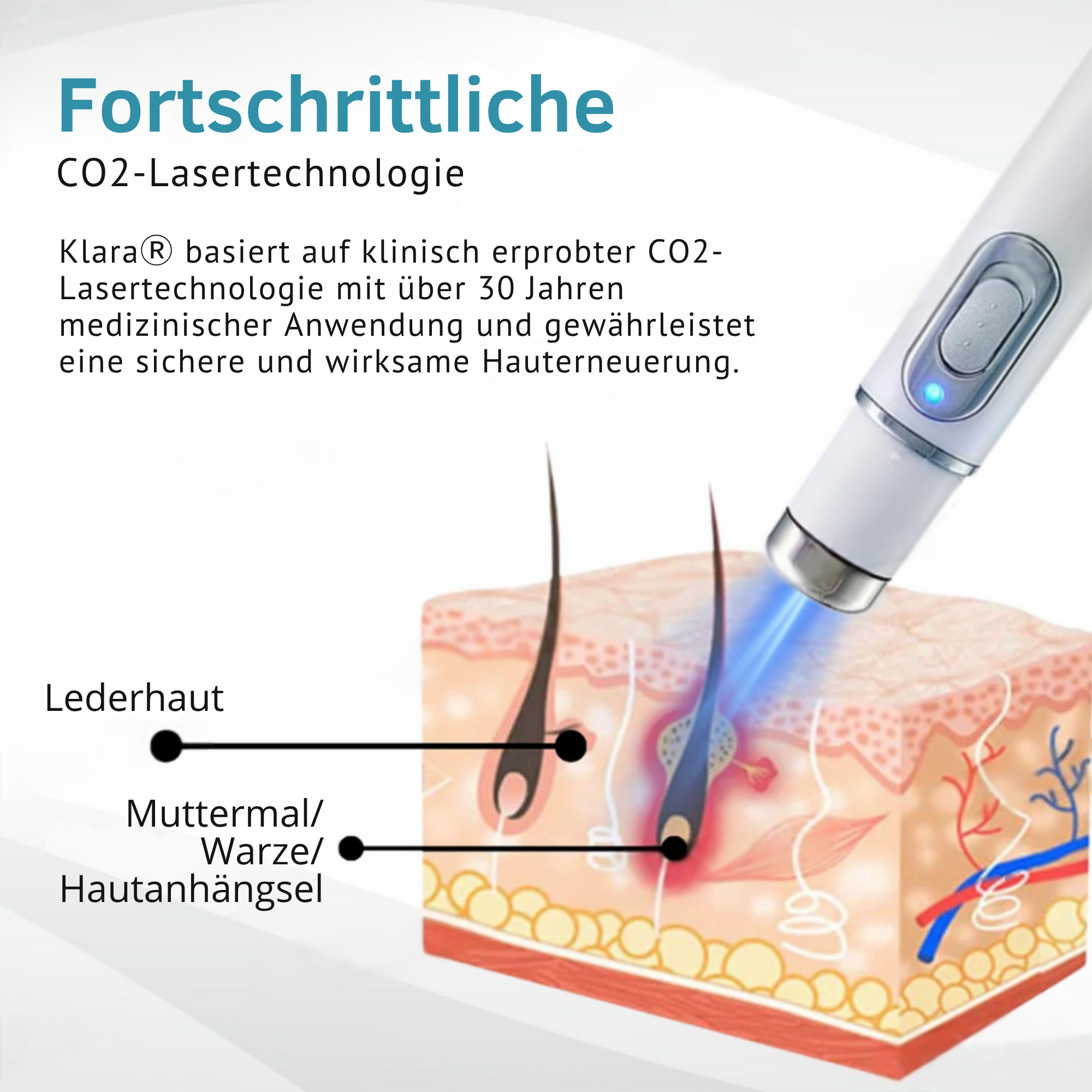 Painless Laser Pen for Flawless Skin and Confidence Anytime
