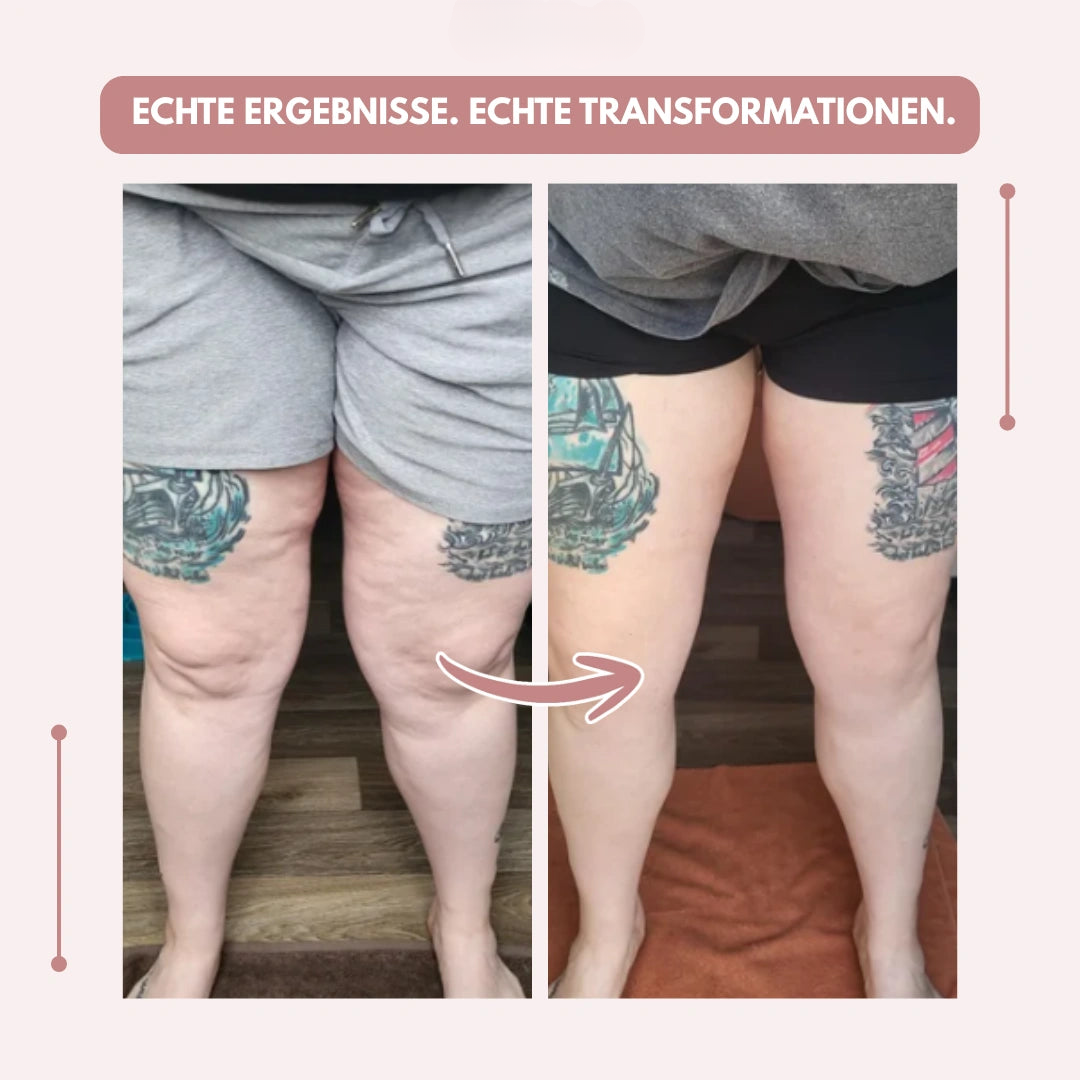 High-Waisted Compression Leggings for Lipoedema Pain Relief