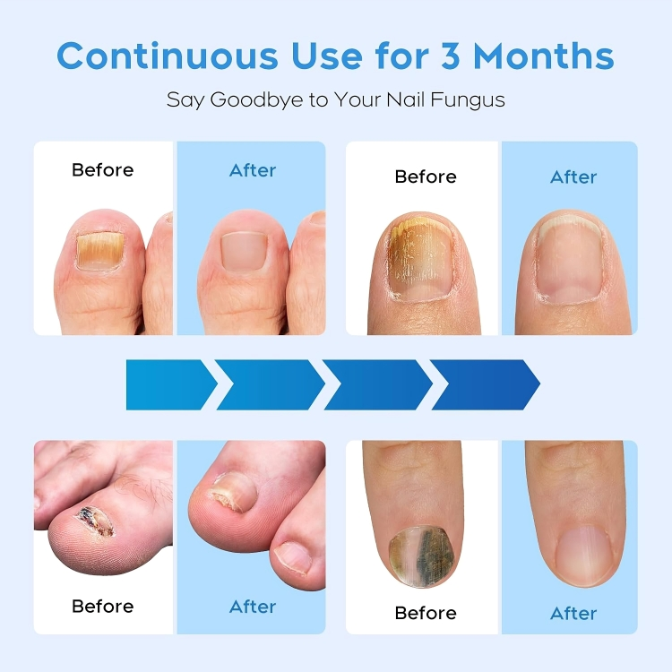Nail Fungus Treatment | Combat and Eliminate Nail Infection