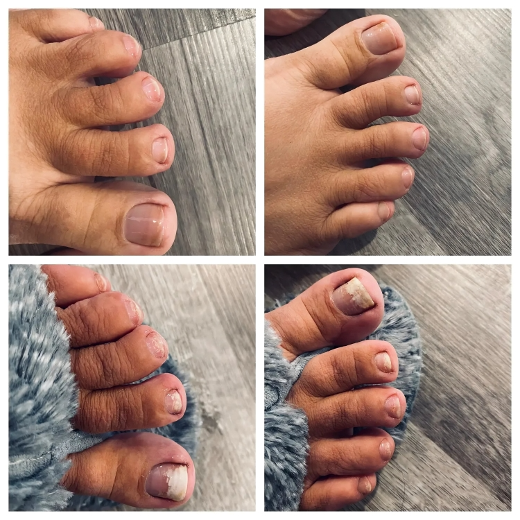 Nail Fungus Treatment | Combat and Eliminate Nail Infection