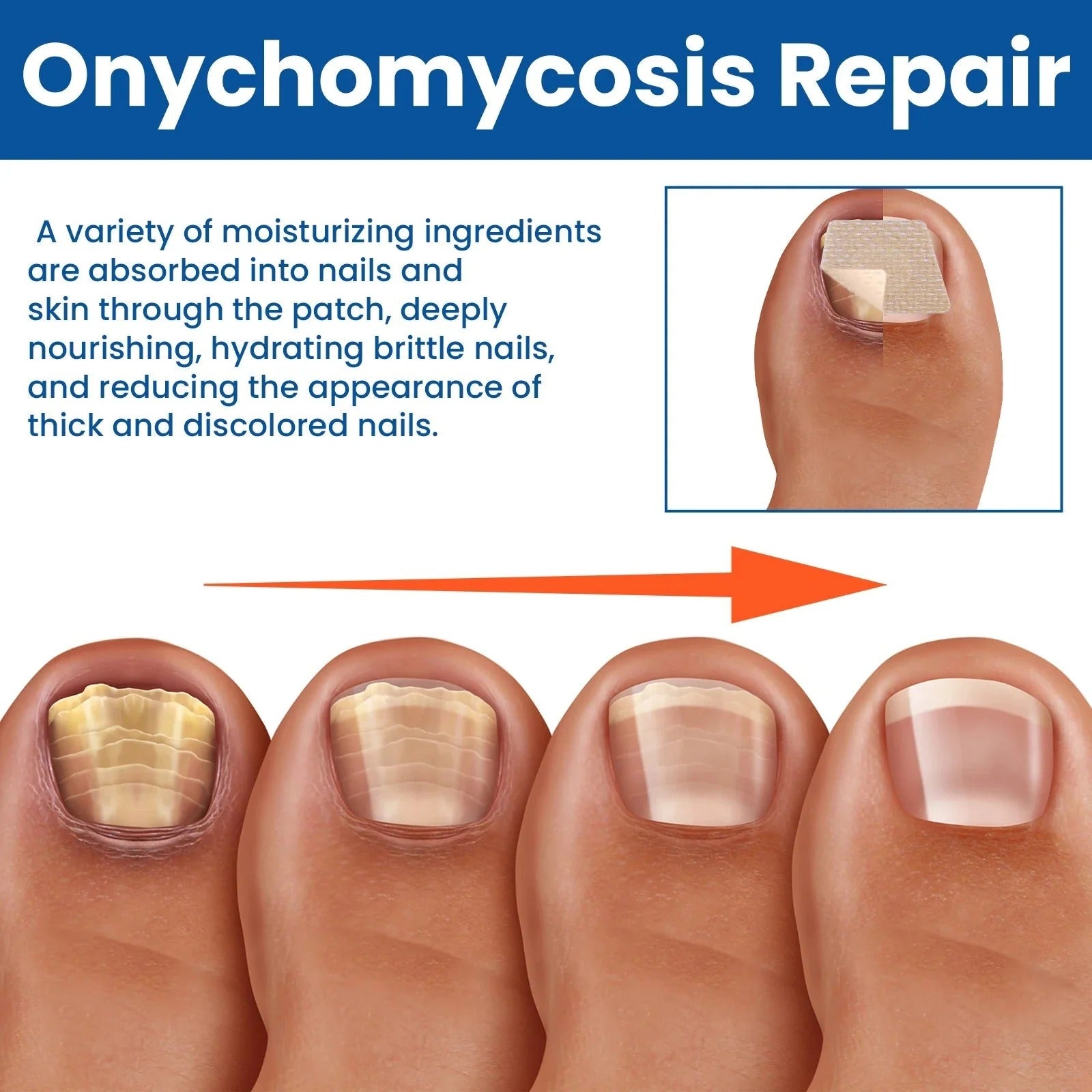 Nail Fungus Treatment Patch | Overnight Care | Regenerating Formula