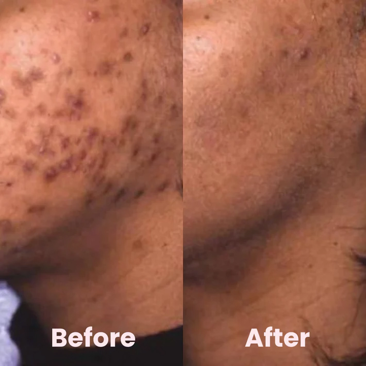 Turmeric Kojic Acid Pads for Radiant Skin