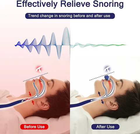 Compact Sleep Apnea Device | Rechargeable via USB & Mask-Free
