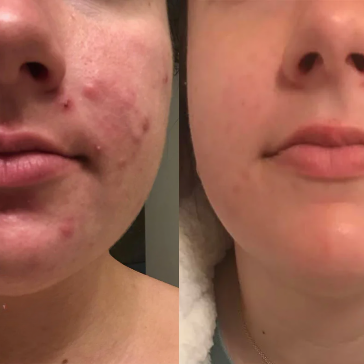 Silicone Scar Sheets for Skin Repair