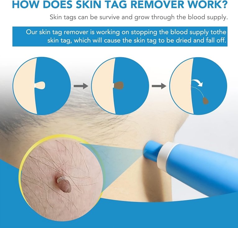 Quick and Safe Removal of Skin Tags