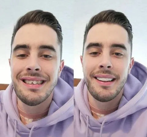 Ultra-Thin Acrylic Resin Veneers for Instant Smile Transformation