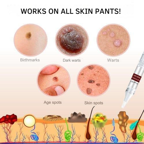 Wart Remover with Precision Applicator for Targeted Treatment – Herbal Formula