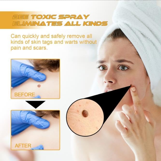 Wart Remover | Targeted Skin Spray | Bee Venom Care Formula