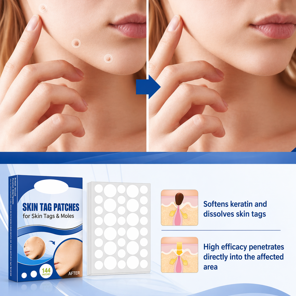 Wart Removal Patches | Discreet Skin Adhesives for Gentle Home Care