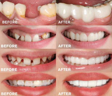 Instant Smile Dental Prosthetics | No Adhesive Needed | Flexible Fit