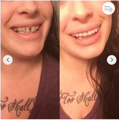 Instant Smile Dental Prosthetics | No Adhesive Needed | Flexible Fit