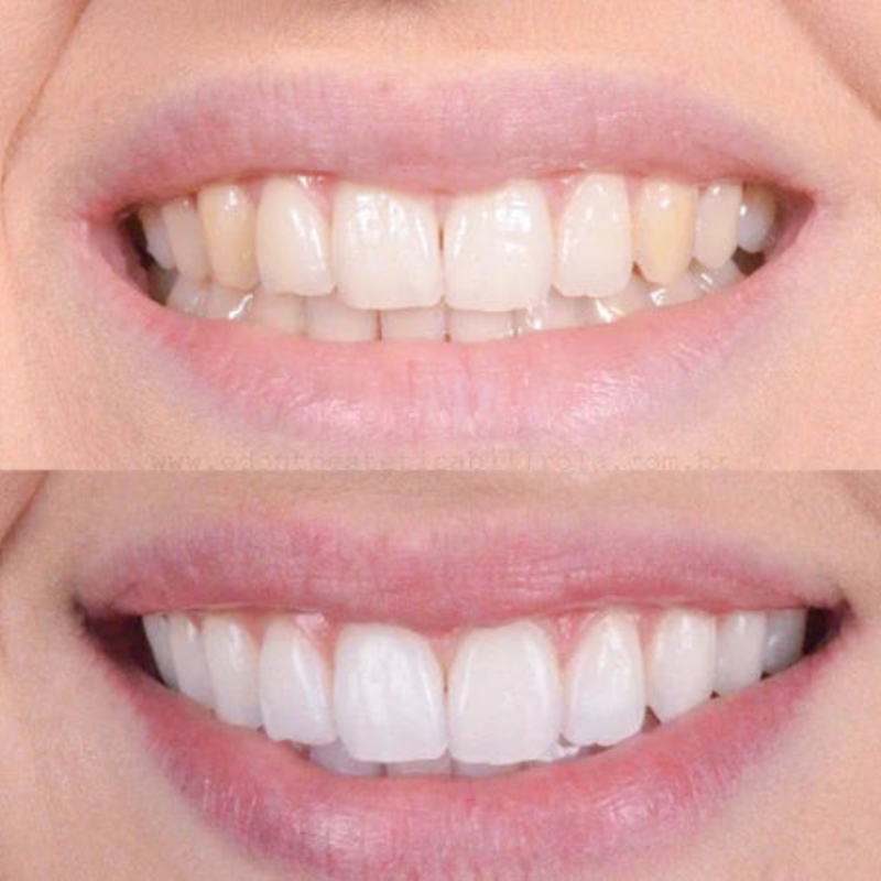 LumaBeam™ — Reveal Your Brightest Smile and Unshakable Confidence Instantly