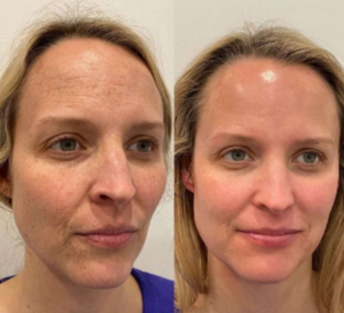 DermaSculpt™ Collagen Infusion — Reveal Firmer, Radiant Skin That Defies Time