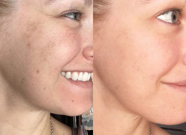 RadianceBurst™ — Melt Away Dark Spots for Skin That Glows Confidence