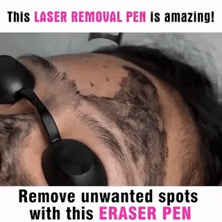 Home Laser Solution for Tattoo and Skin Blemish Removal