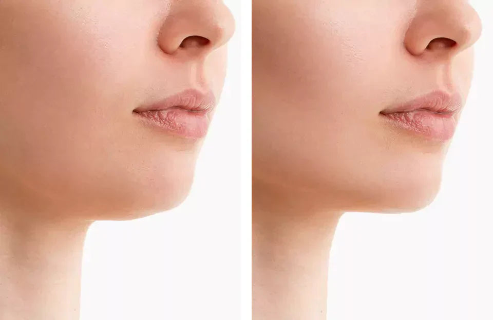 Sculpting Light Therapy Belt for a Defined Jawline