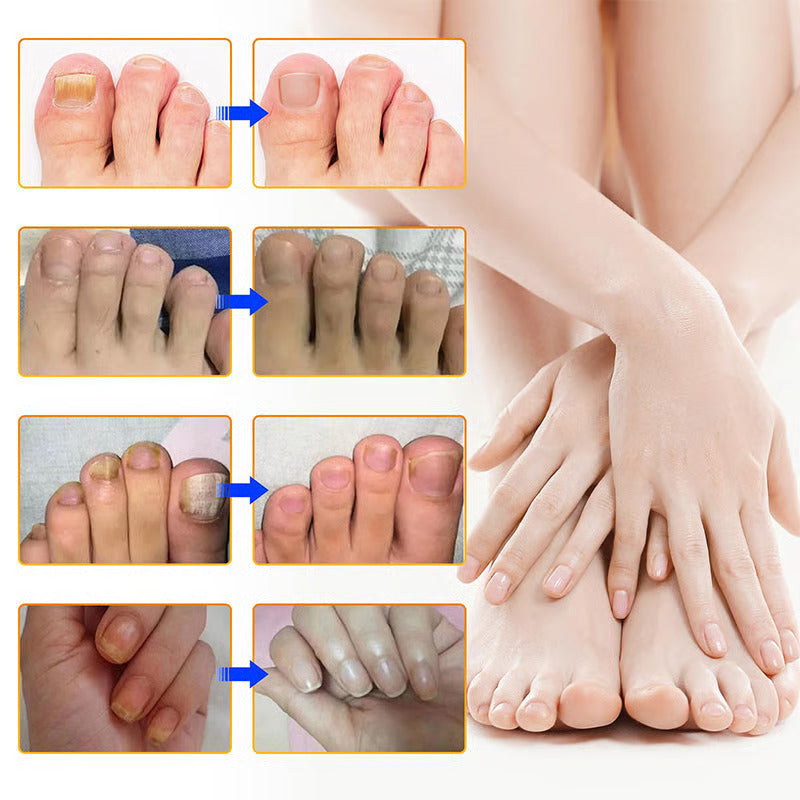 SilkDerm™ Nail Renewal Patches — Clear, Strong Nails That Make You Proud to Bare Your Feet