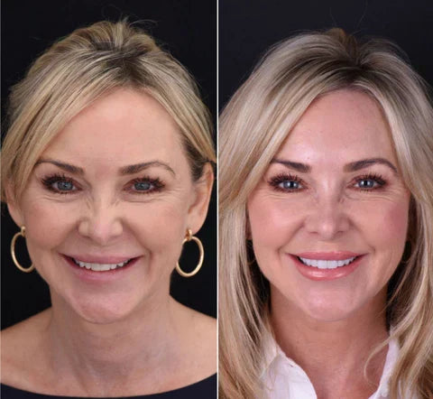 Transform Your Smile Instantly with Custom Fit Veneers