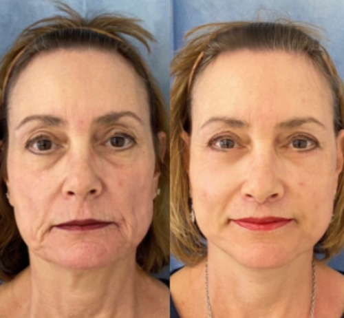 DermaSculpt™ Collagen Infusion — Reveal Firmer, Radiant Skin That Defies Time