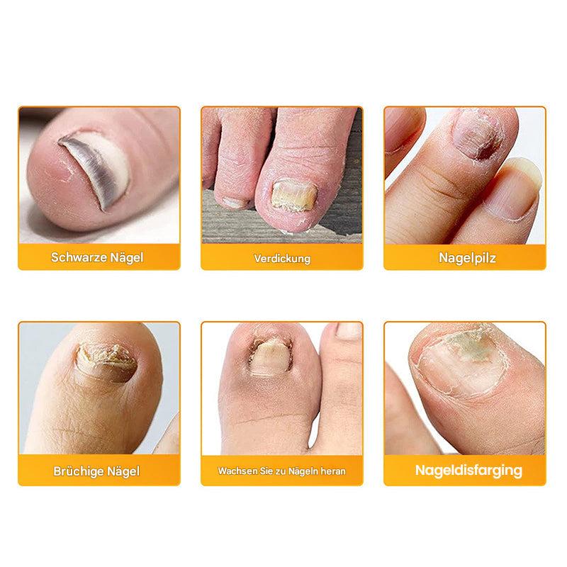 ClearVita™ Nail Renewal Patches — Reveal Stunning, Healthy Nails Without the Hassle