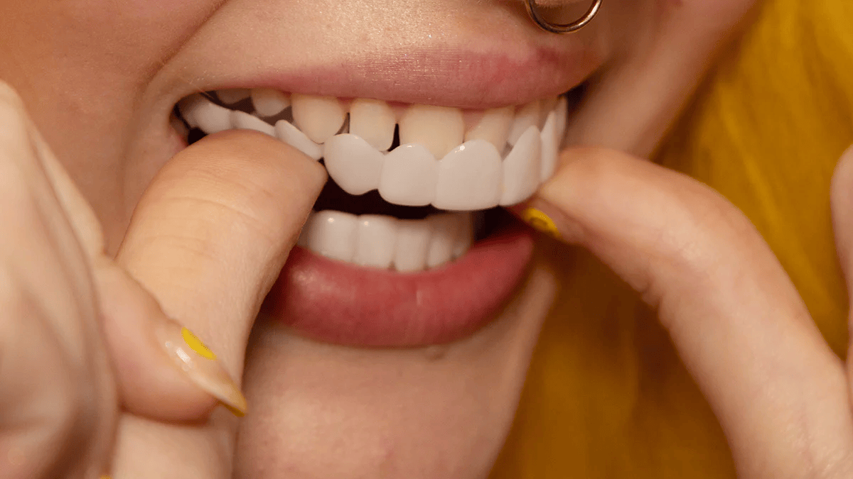 Transform Your Smile Instantly with Custom Fit Veneers