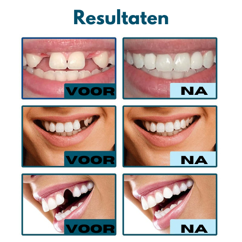 GlideSmile™ — Snap On a Stunning Smile That Turns Heads Instantly