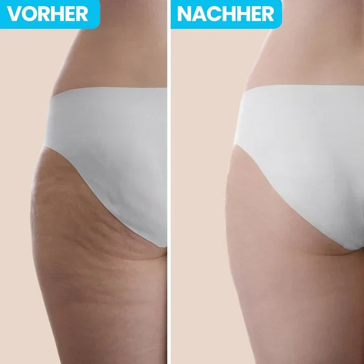 Glissea™ — Melt Away Cellulite and Unleash Your Silky Smooth Confidence