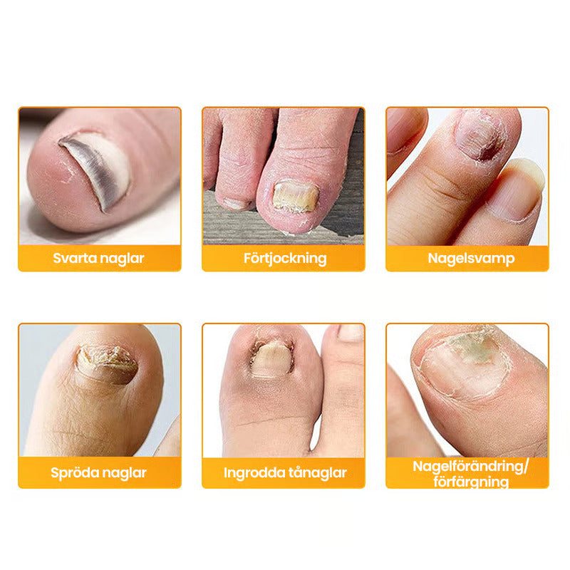 SilkDerm™ Nail Renewal Patches — Clear, Strong Nails That Make You Proud to Bare Your Feet