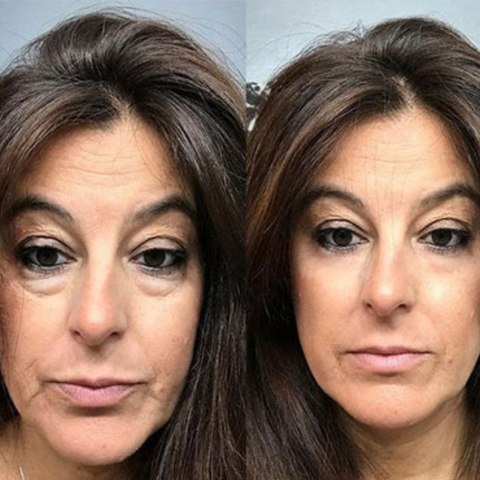 EyeVerra™ — Smooth Away Wrinkles Instantly for Youthful, Radiant Eyes