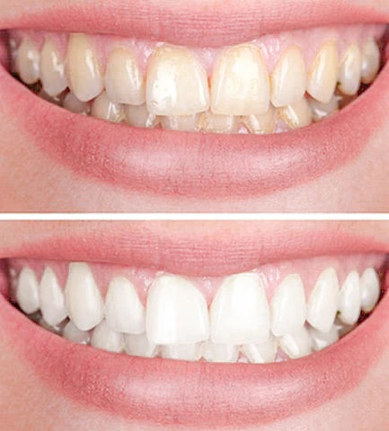 GlowBrilliance™ — Instantly Brighten Sensitive Teeth and Defend Your Smile with Confidence