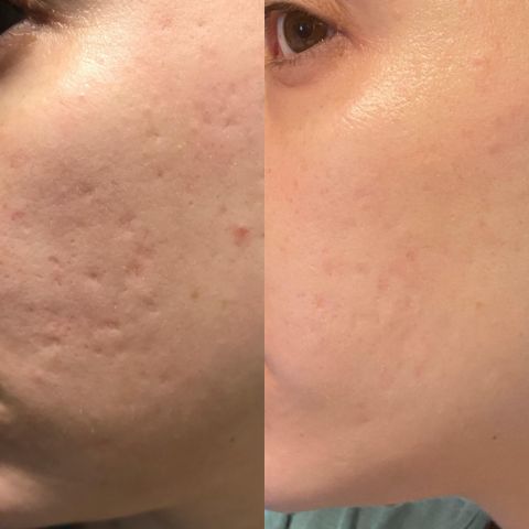 Arvilaro™ - Silicone Scar Sheets