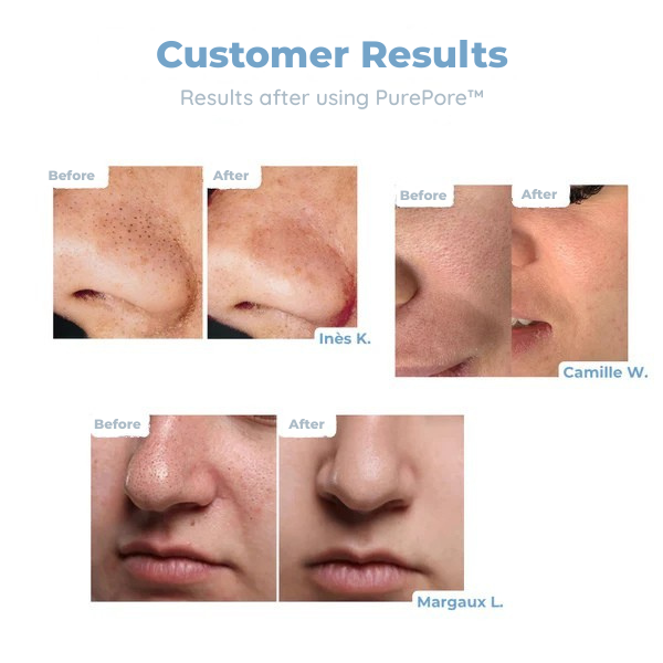 ClariSkin™ — Banish Blackheads and Unleash Radiant, Touchably Smooth Skin