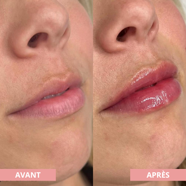 Arvilaro | Kit Ritual Lips - Thicker & Shiny lips in minutes