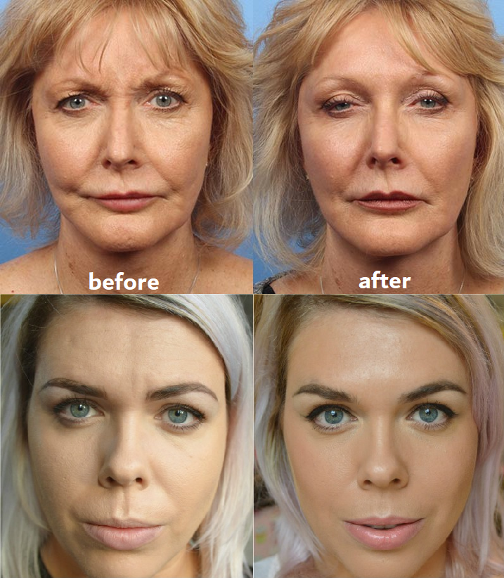 Wrinkle Reduction Pads